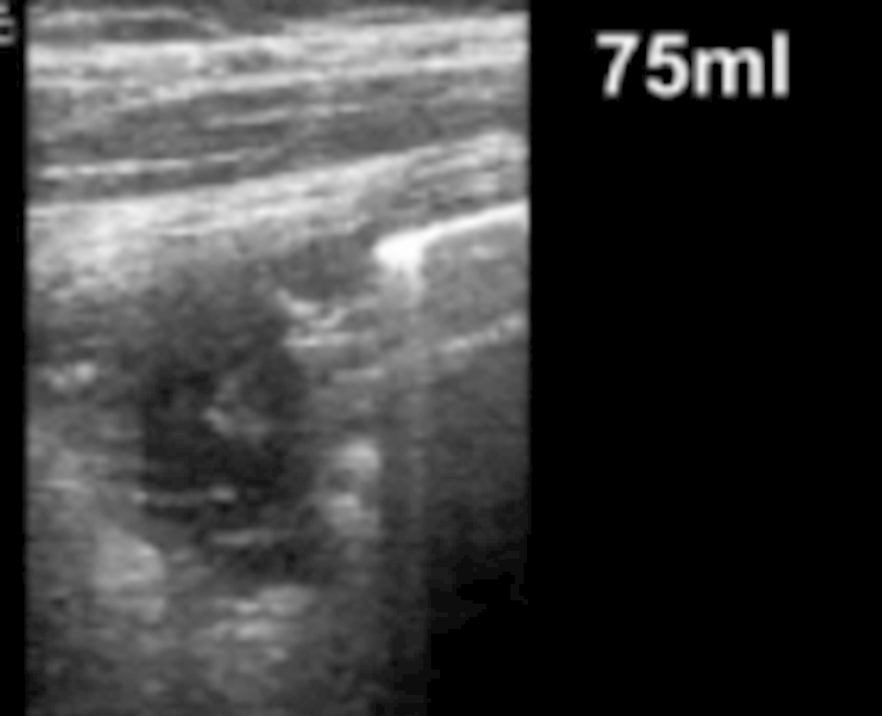 Ultrasonography during bronchoalveolar lavage of lung cavities